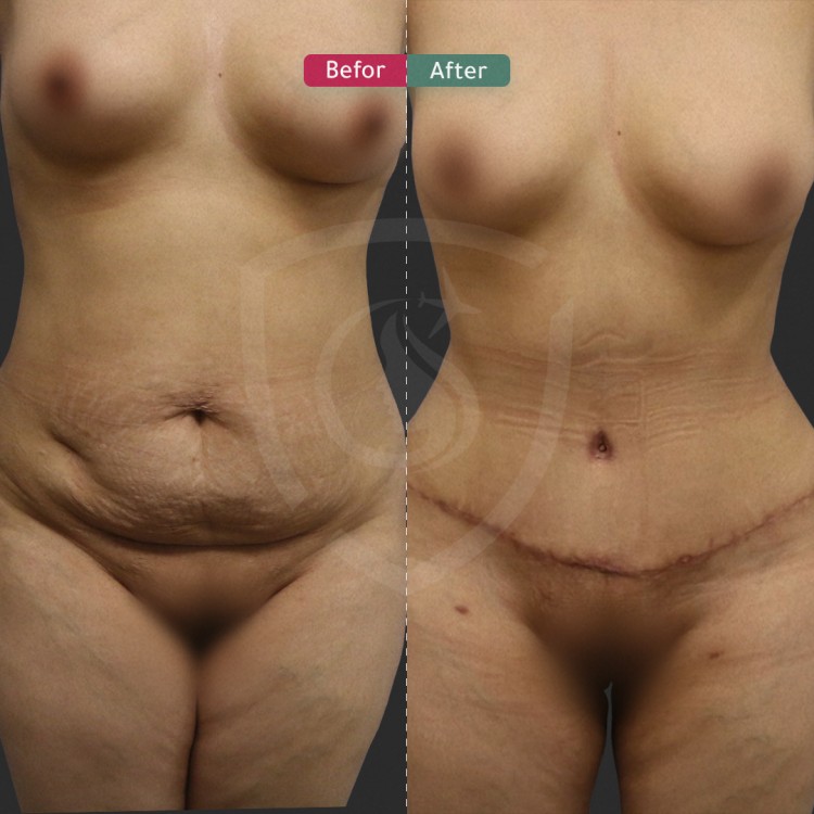 sleeve gastrectomy before and after